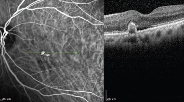 Diagnosing PCV With OCT B-Scan - Retina Today