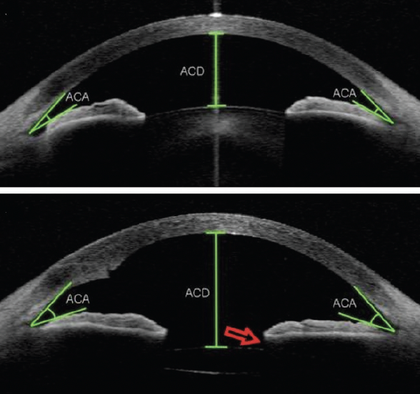 Reducing Pigment Particles in the Anterior Chamber Today