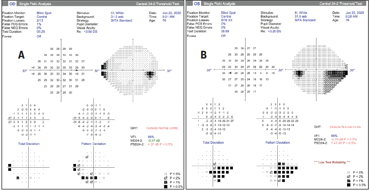 Corneal Pannus - Glaucoma Today