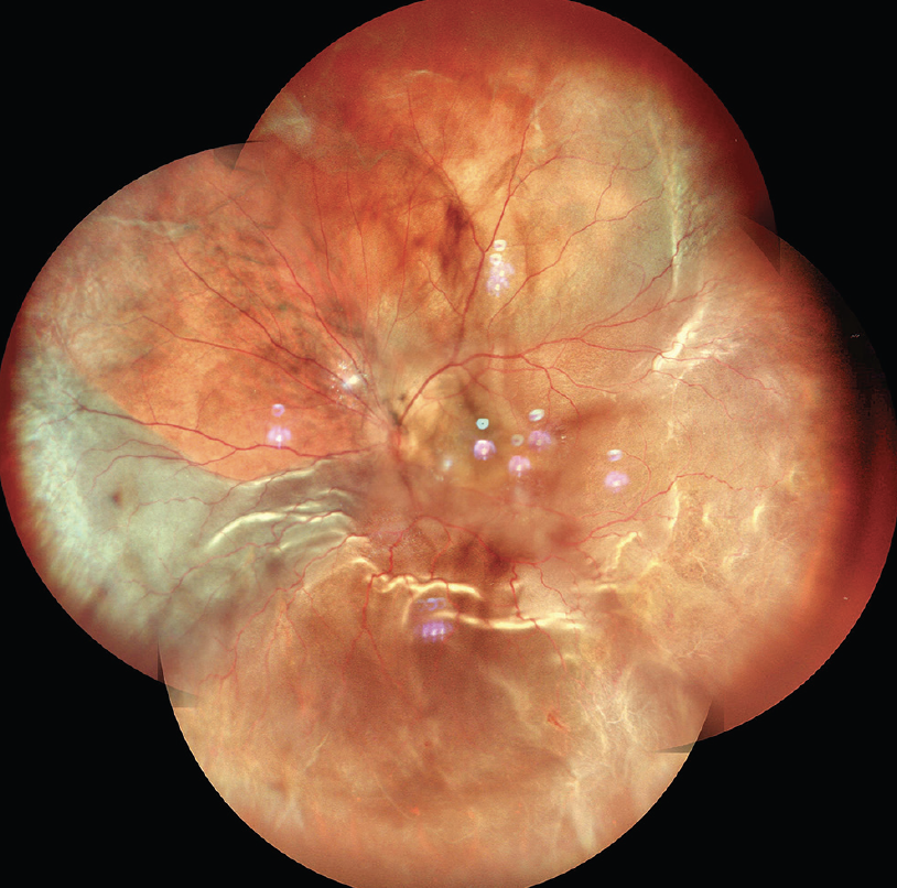 SLO-Based Widefield Imaging: An Atlas Of Retinal Detachments - Retina Today