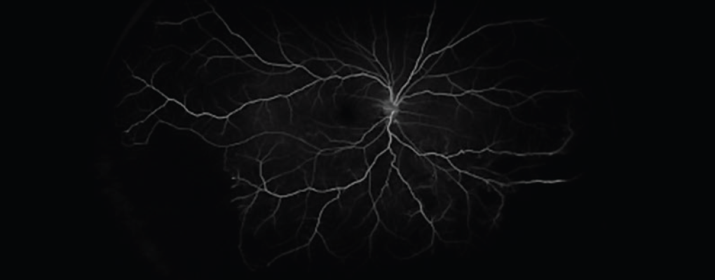 An Unusual Case of Unilateral Purtschers Retinopathy - Retina Today