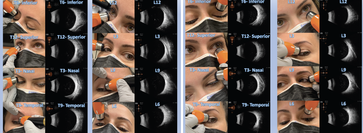 A Primer On Diagnostic Ophthalmic Ultrasound - Retina Today