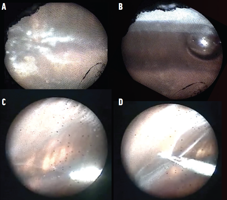 Endoscopy-Assisted Vitrectomy: Tips to Improve the View - Retina Today