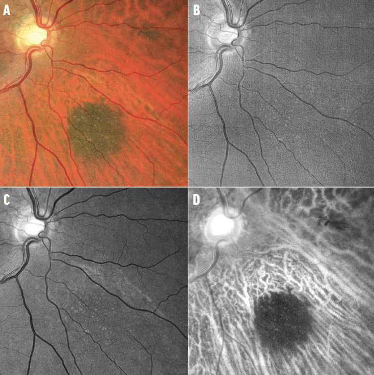 Let’s Talk About Retinal Imaging Analysis Retina Today