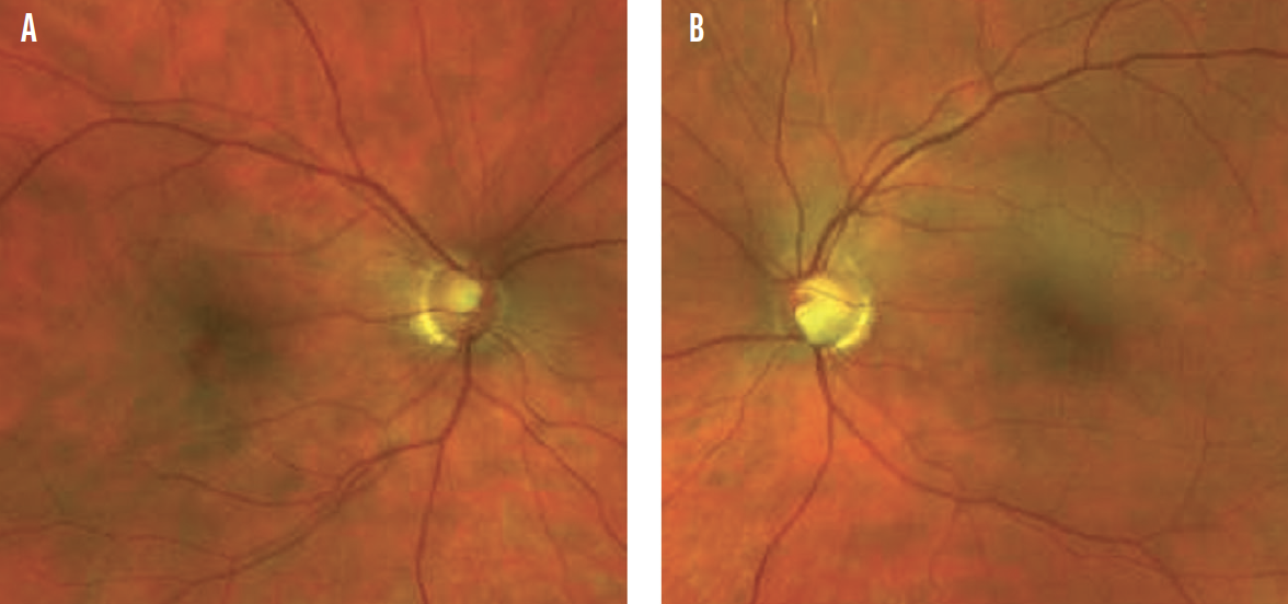 optic-nerve-sheath-meningioma-eyetoday