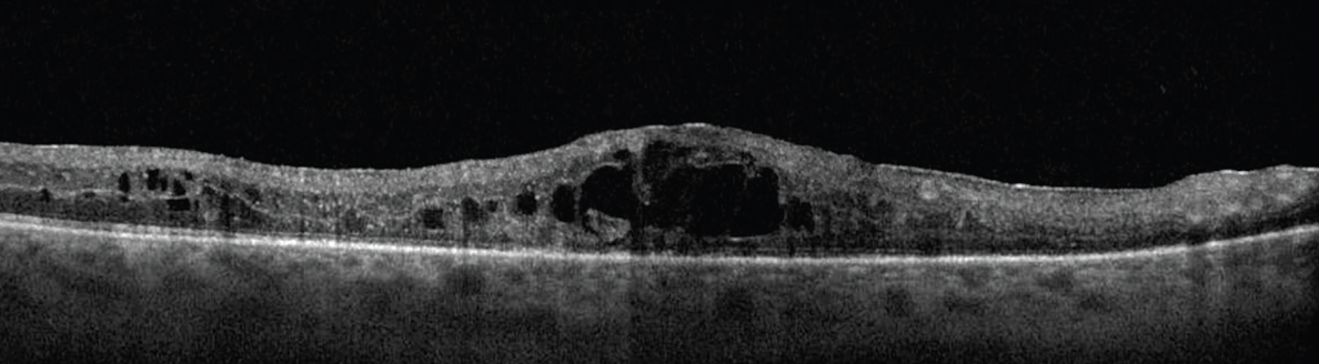 A DRCR Retina Network Update A To Z - Retina Today