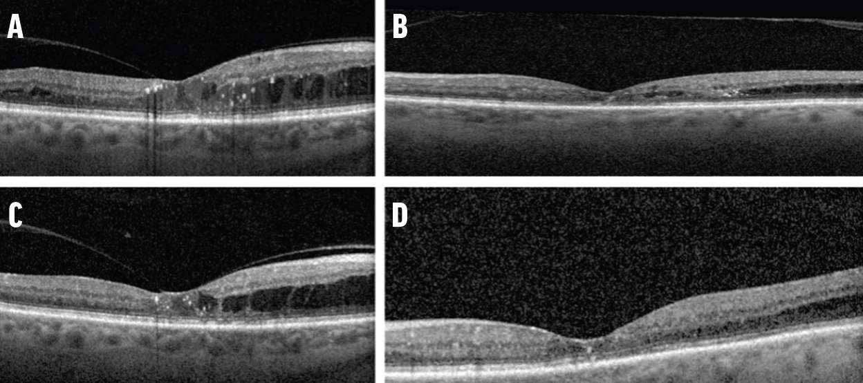 Managing DR One Case at a Time - Retina Today