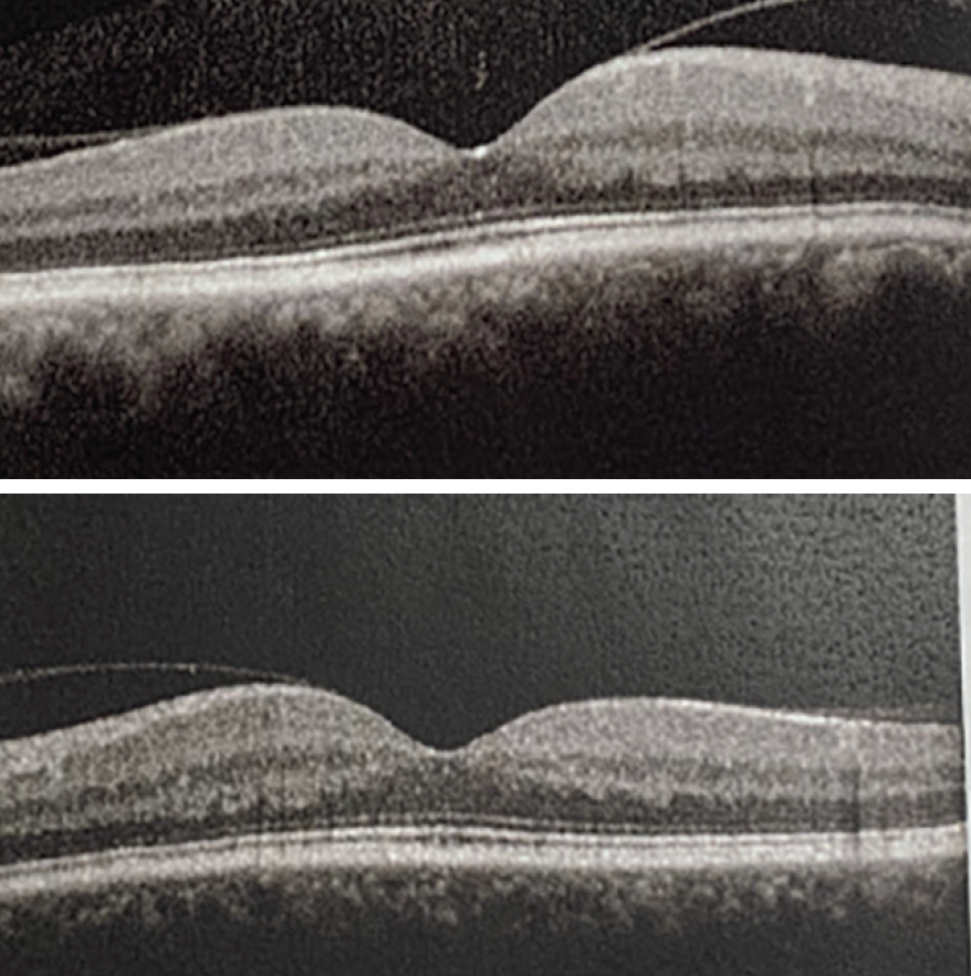 Cystoid Macular Edema With an Oncology Twist Retina Today