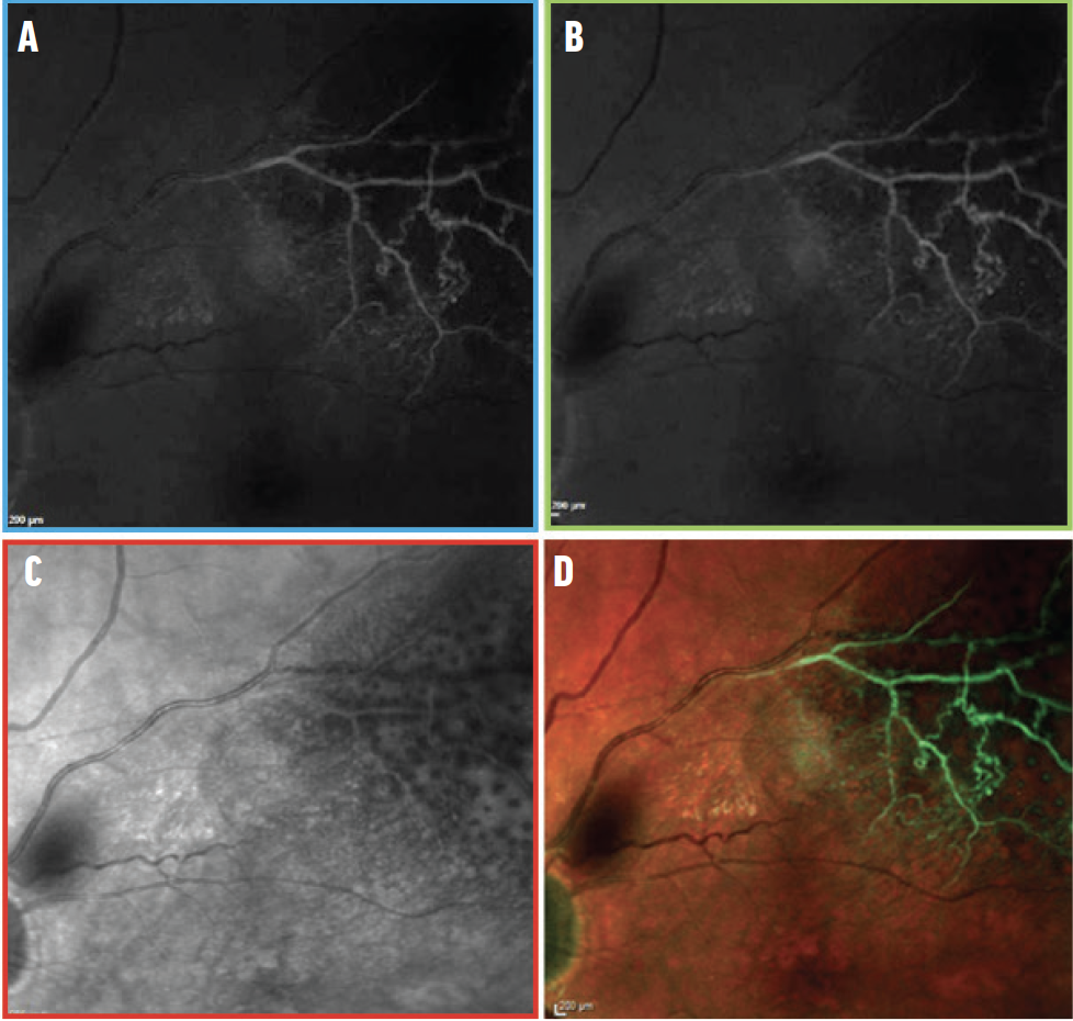 Defining Ocular Ischemic Processes: An Atlas - Retina Today