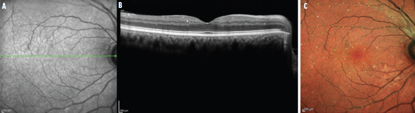 Defining Ocular Ischemic Processes: An Atlas - Retina Today