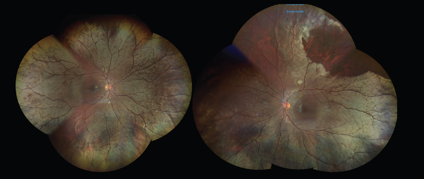 MizuoNakamura Phenomenon in Xlinked Retinoschisis Retina Today