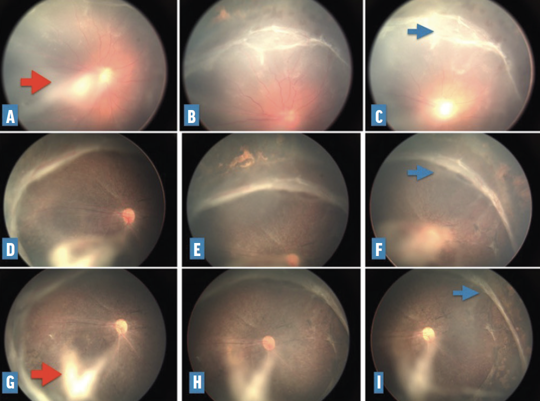 retinopathy of prematurity stage 3