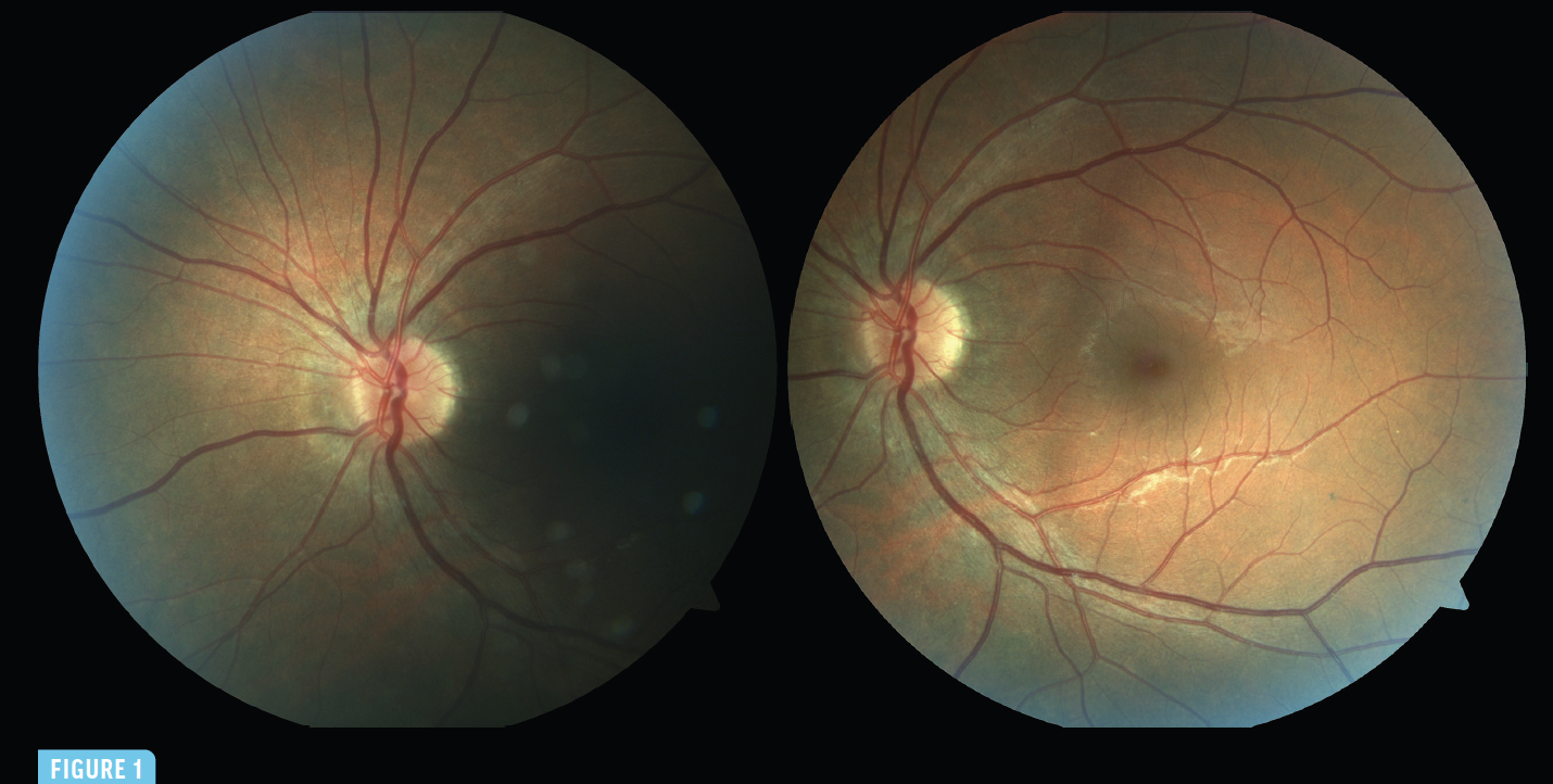 The Case of the Enormous Blind Spot - Retina Today