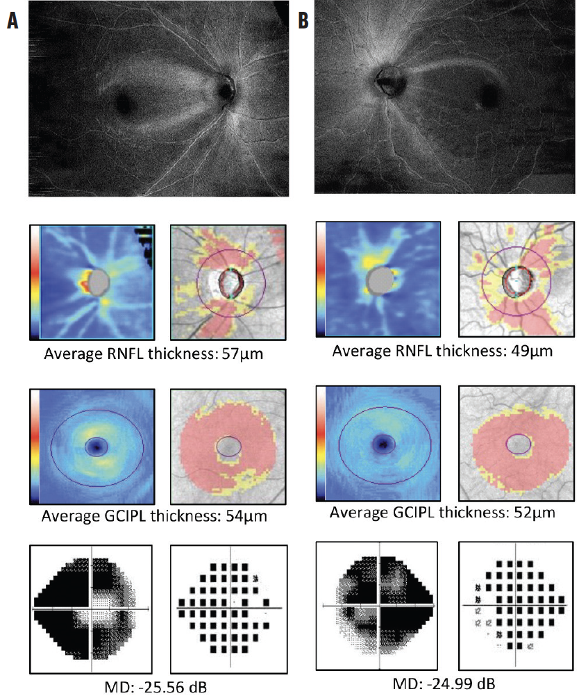 Retinal Nerve Fiber Layer Optical Texture Analysis Glaucoma Today