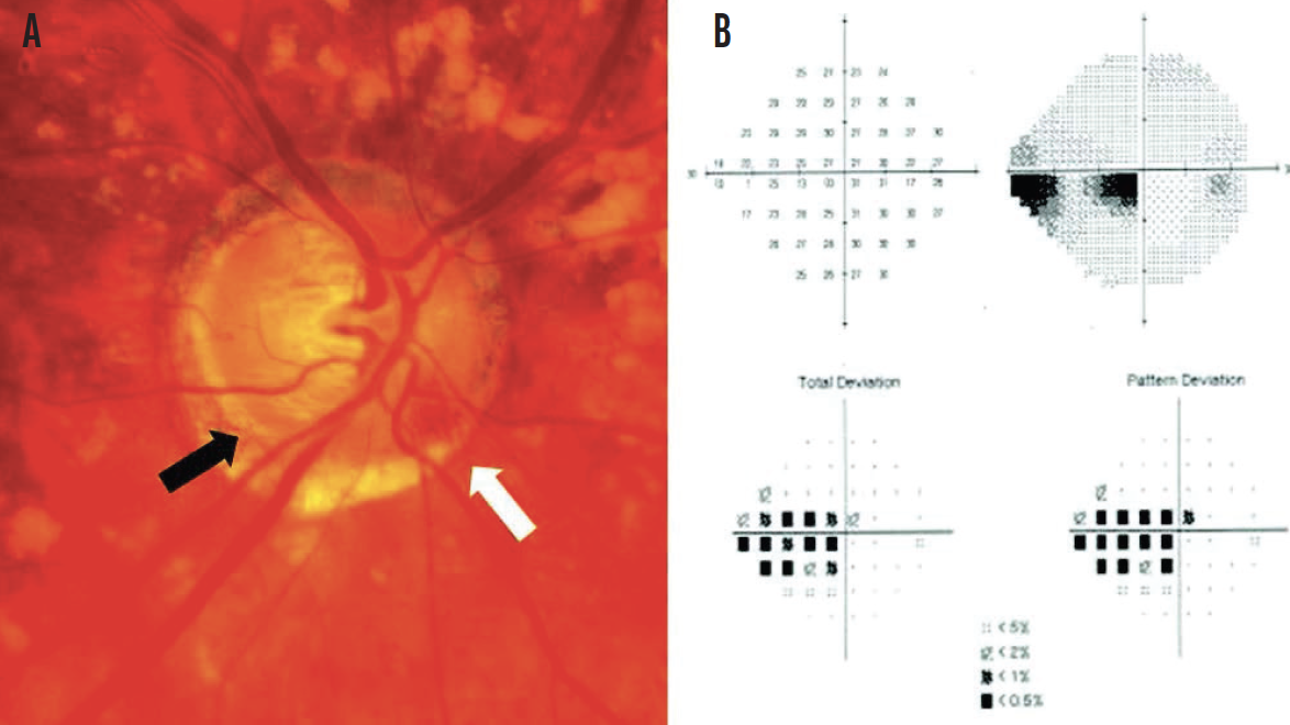 Normal Tension Glaucoma Pathogenesis Glaucoma Today