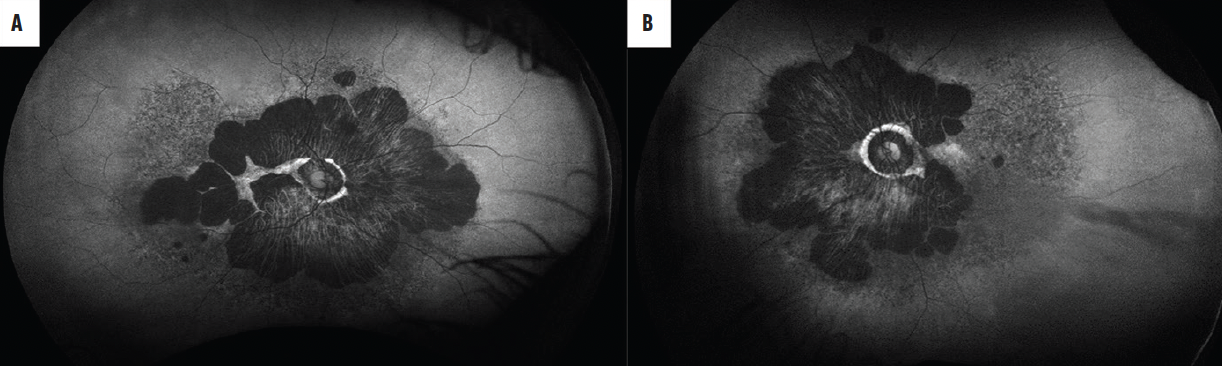 Thioridazine Retinal Toxicity - Retina Today