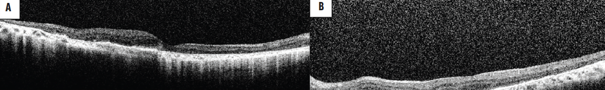 Thioridazine Retinal Toxicity - Retina Today