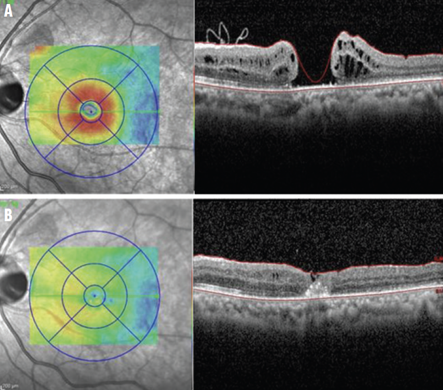Macular Hole Formation After PPV With ILM Peeling - Retina Today