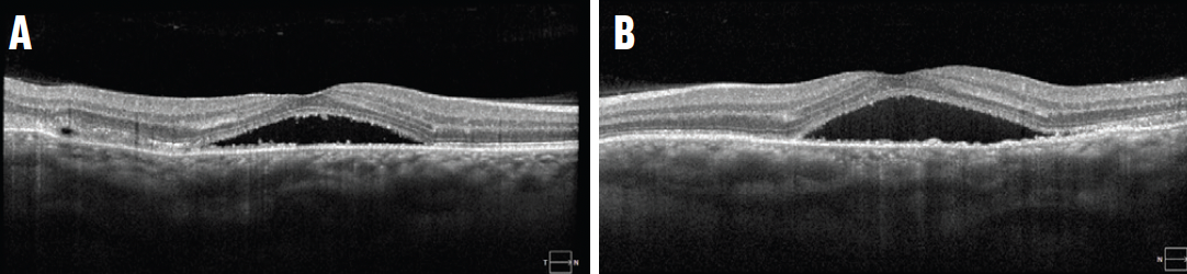 Choroidal Metastasis Associated With Oropharyngeal Carcinoma - Retina Today