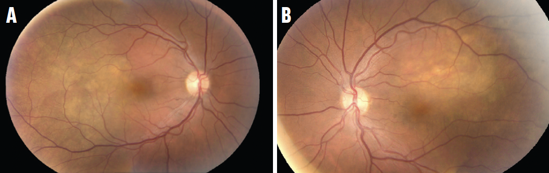 Choroidal Metastasis Associated With Oropharyngeal Carcinoma - Retina Today