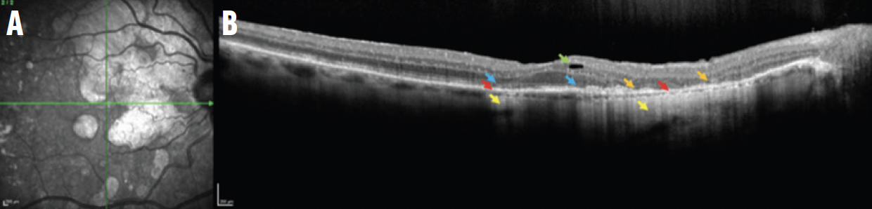 Figura 1. Imágenes NIR (A) y un OCT B-scan de una lesión cRORA (B) muestran la interrupción de la ELM y EZ (flechas azules) y regiones de atenuación del EPR (flechas rojas) con hiperTD asociados en la coroides (flechas amarillas). Hay áreas de degeneración de fotorreceptores (flechas naranjas) y un quiste degenerativo incidental (flecha verde).