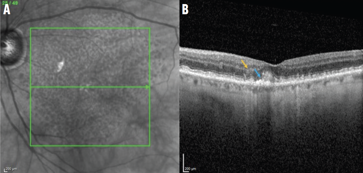 Figura 2. Las imágenes NIR (A) y un OCT B-scan de una lesión iRORA (B) muestran la alteración de la ELM y la EZ (flecha azul) y el hundimiento de la INL (flecha naranja).