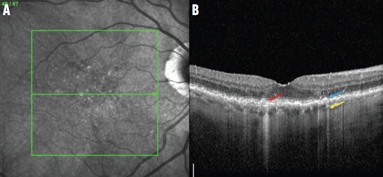 Figura 3. Las imágenes NIR (A) y un OCT B-scan de una lesión iRORA (B) muestran la alteración de la ELM y la EZ (flecha azul) y la atenuación focal del EPR (flecha roja) con hiperTD asociados en la coroides (flecha amarilla).