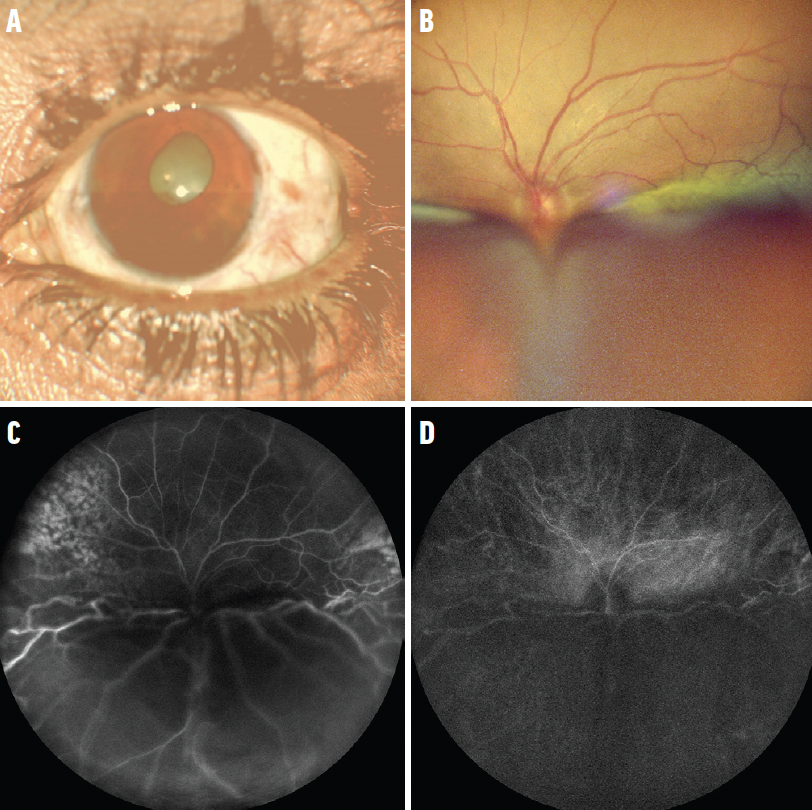 Diagnostic Yield in NonDilating Pupils Retina Today