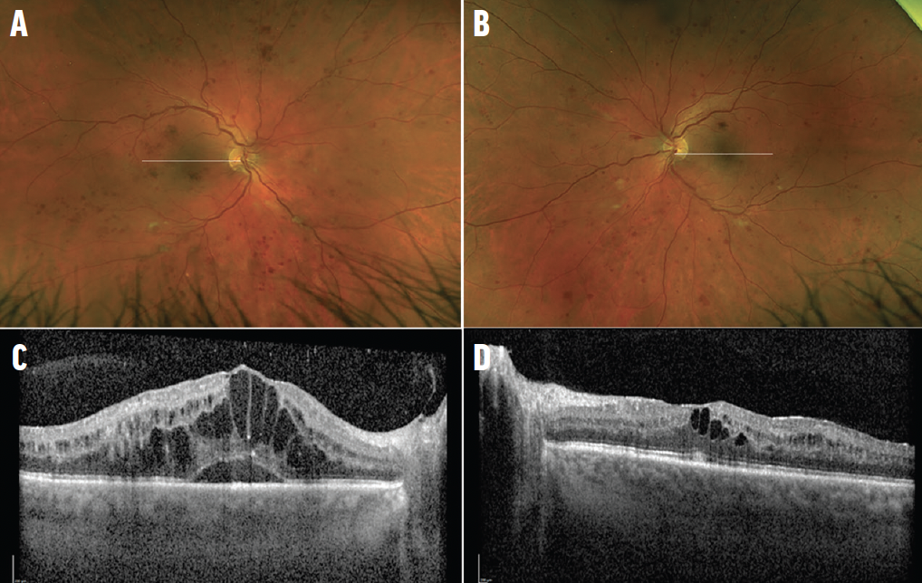 Cotton-wool spots - American Academy of Ophthalmology