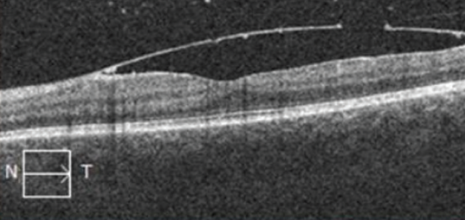 High-Altitude Retinopathy: A Review - Retina Today