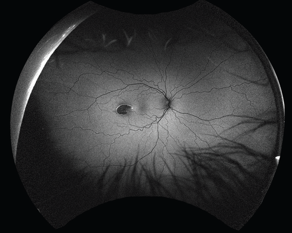 Torpedo Maculopathy - Retina Today