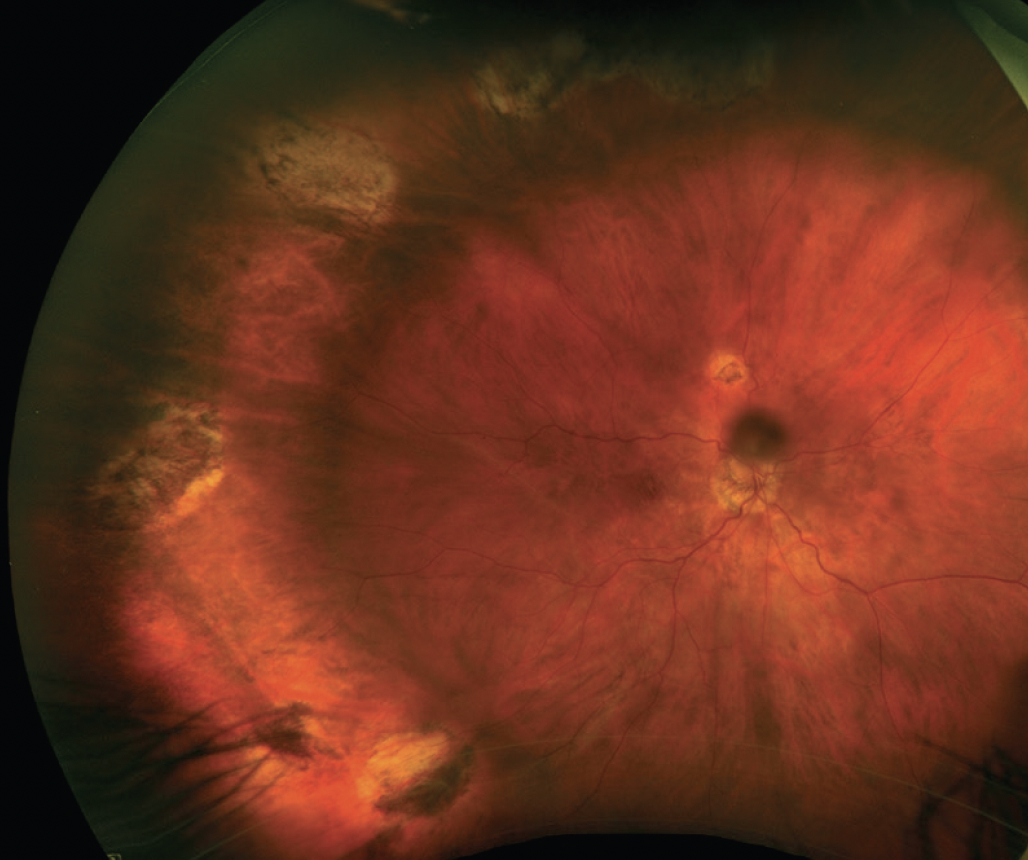 New Concepts In Proliferative Vitreoretinopathy - Retina Today