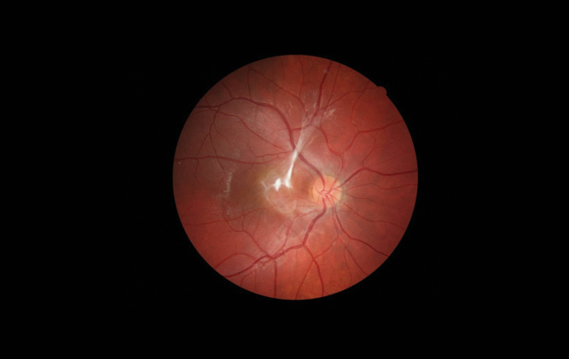 Combined Hamartoma of the Retina and RPE Retina Today
