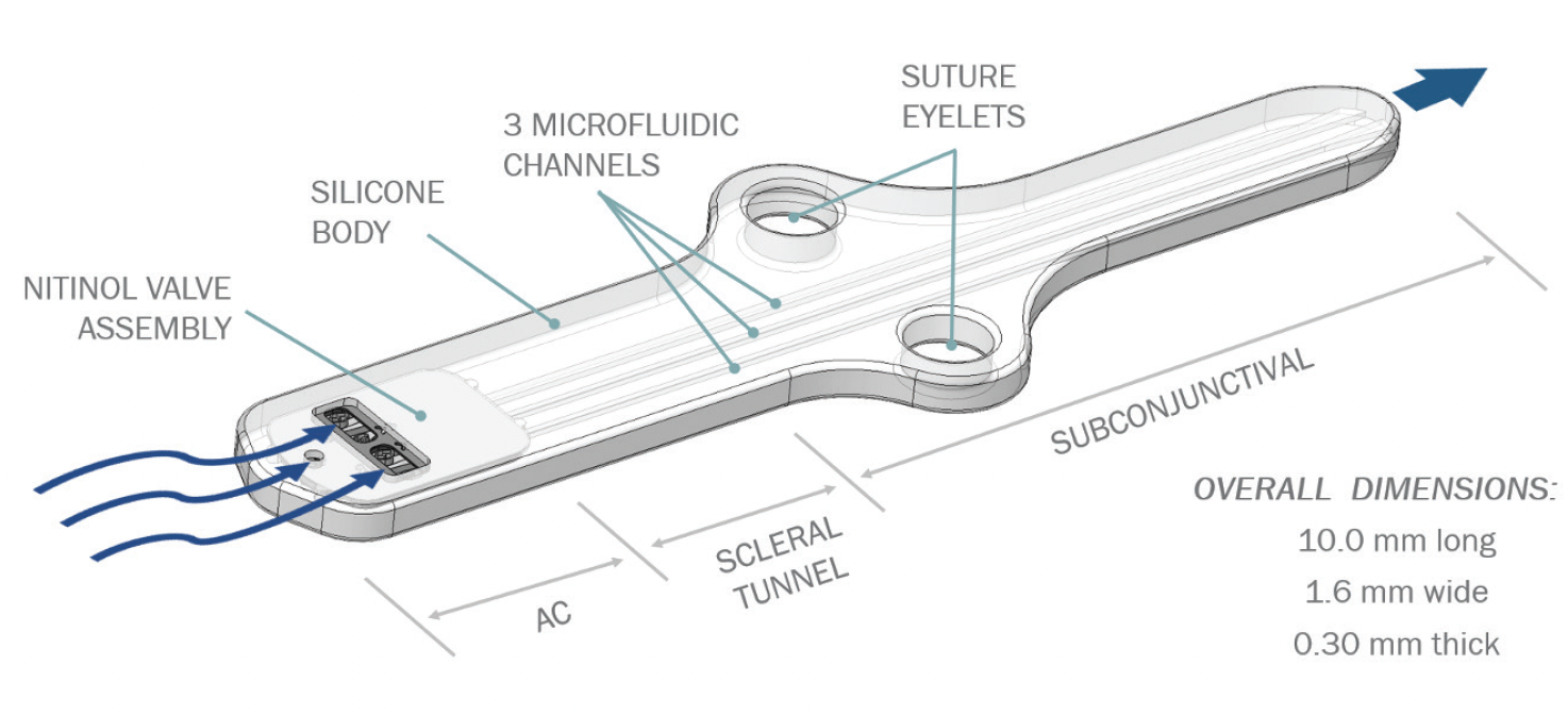 The Calibreye System - Glaucoma Today