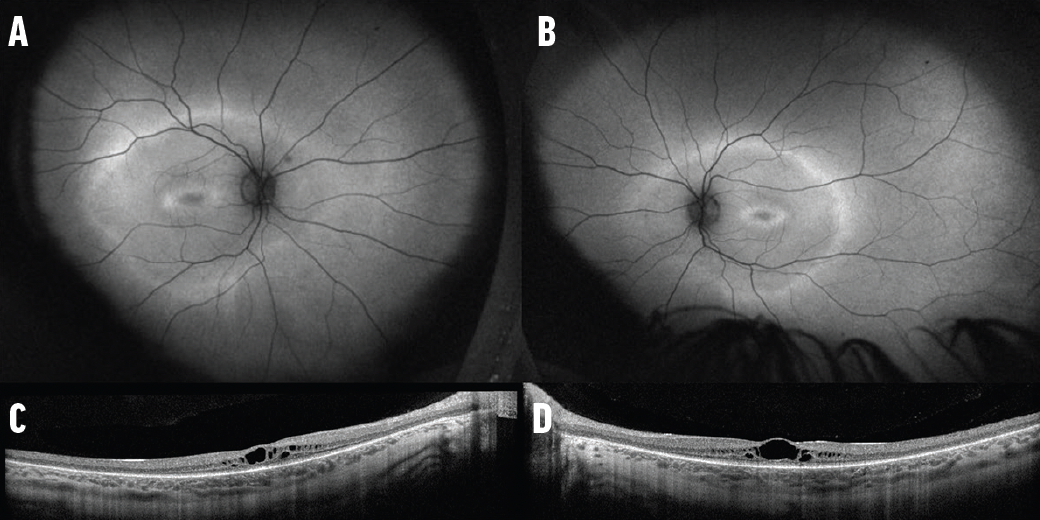 Test Your Diagnostic Acumen: IRD Mystery Cases - Retina Today