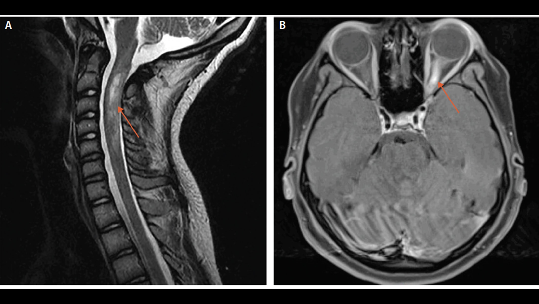 NMOSD Lesions - The Neurology Hub