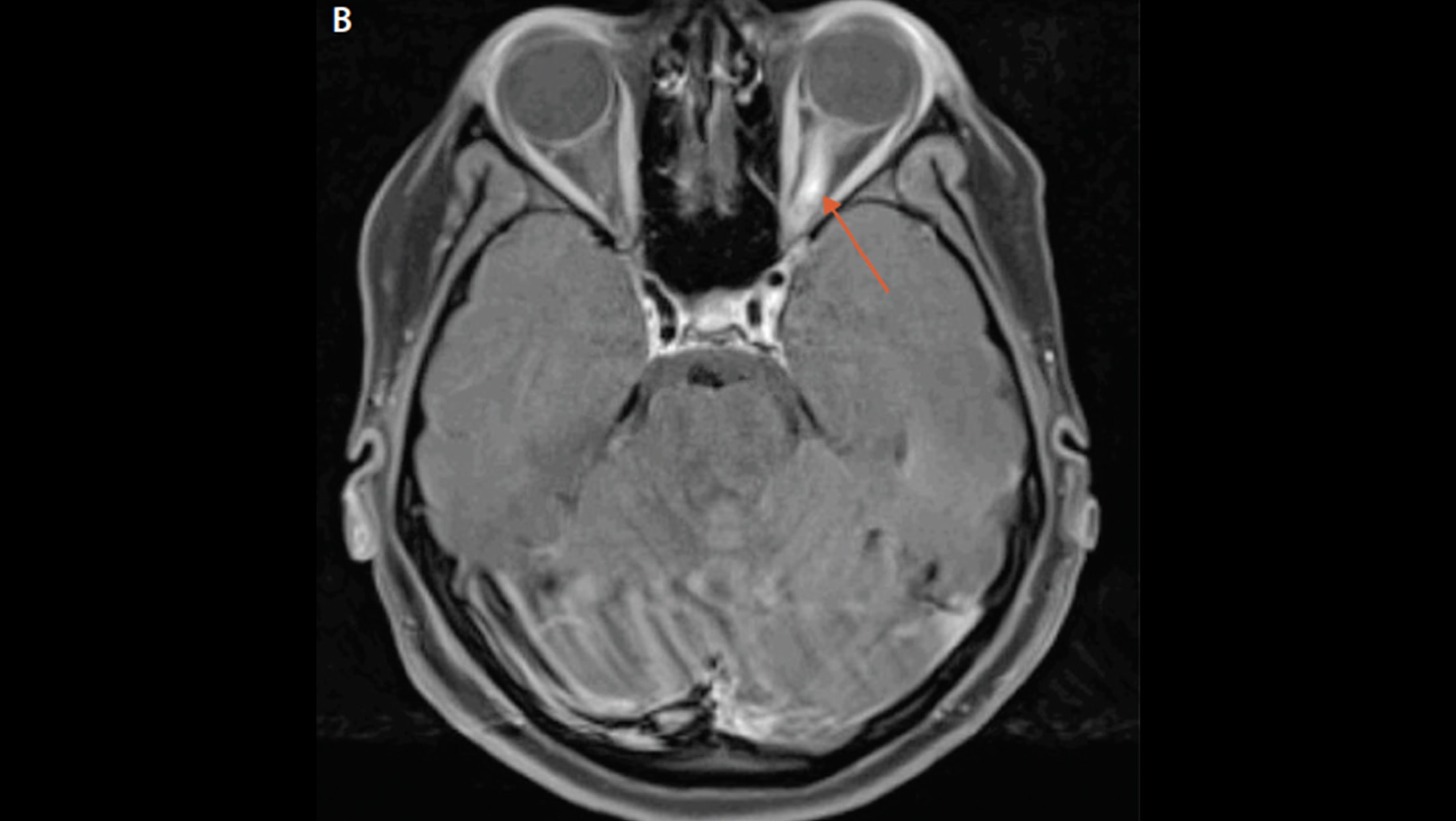 What Does A Lesion On The Optic Nerve Mean