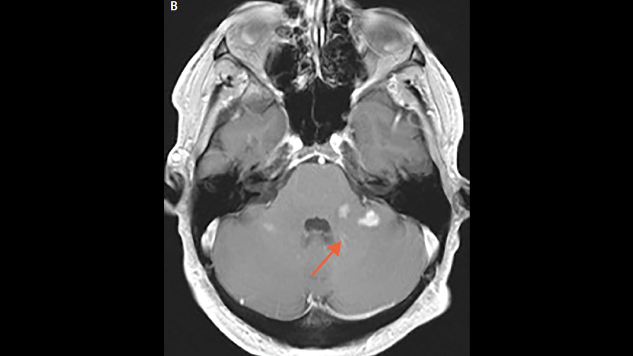 Optic Nerve Lesions The Neurology Hub