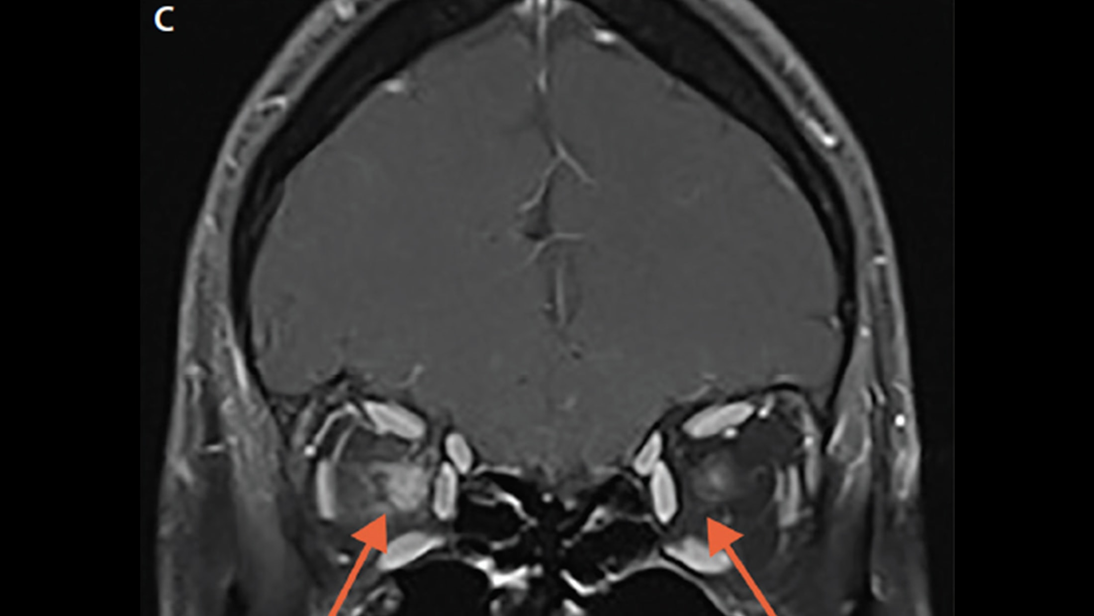 optic-nerve-lesions-the-neurology-hub