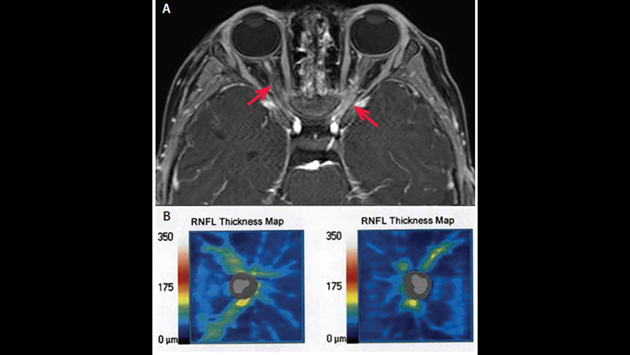 optic-nerve-lesions-the-neurology-hub