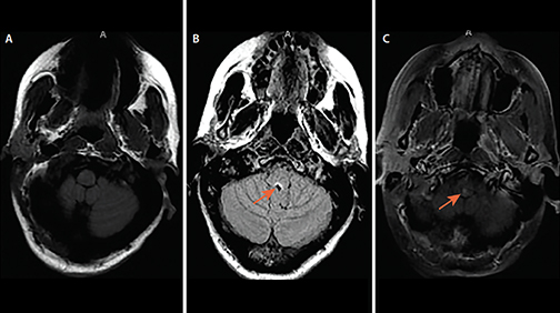 Other Non-MS Demyelinating Lesions - The Neurology Hub