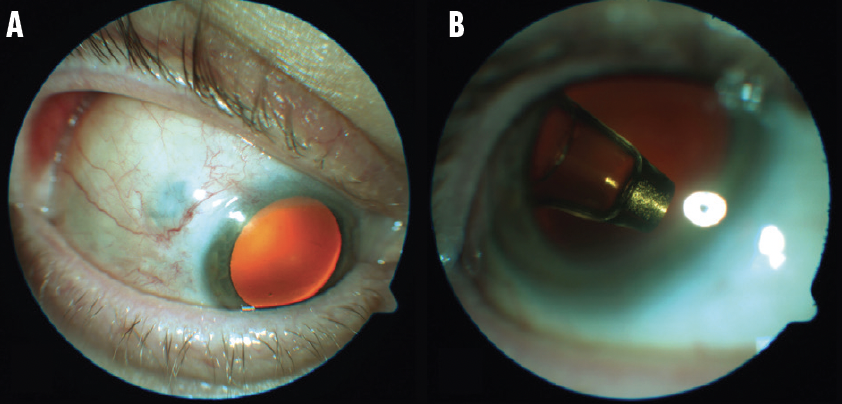 Imagen. Estas imágenes del PDS demuestran un excelente cierre postoperatorio de la conjuntiva suprayacente (A) y un buen posicionamiento intraocular en la cámara vítrea (B).