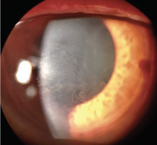 Side Effects of Glaucoma Medications Glaucoma Today