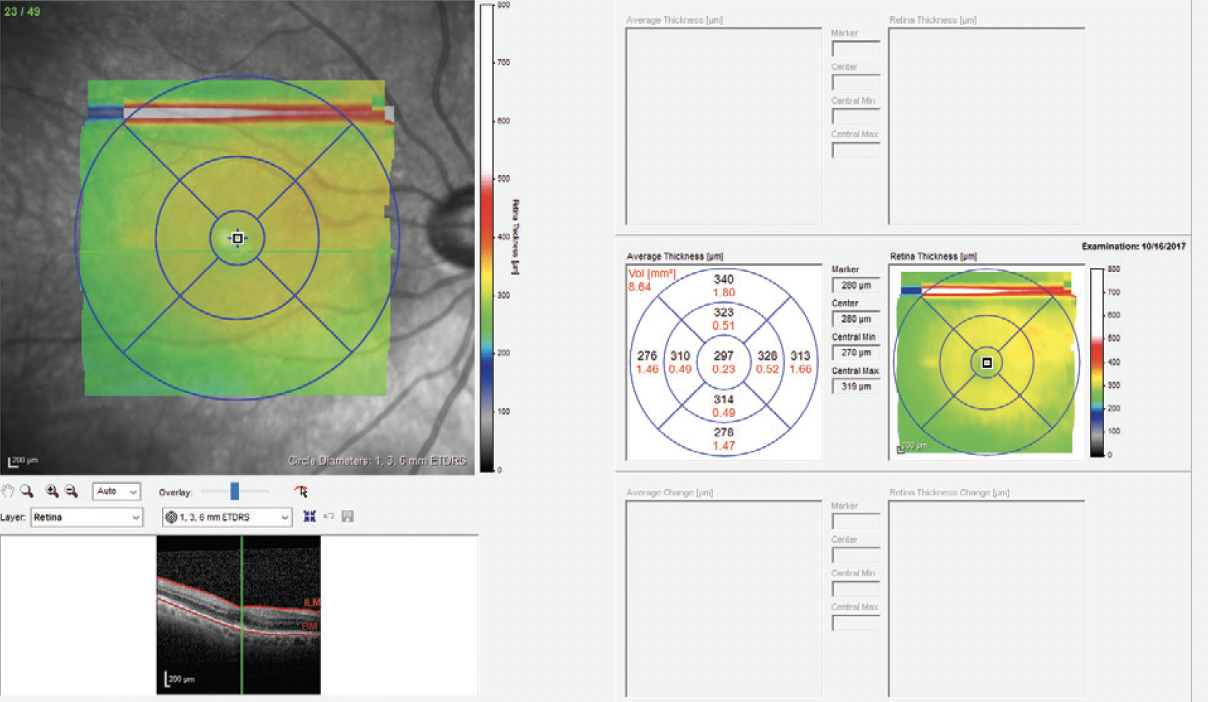 Managing Chronic Idiopathic Noninfectious Uveitis Affecting The Posterior Segment Retina Today 4329