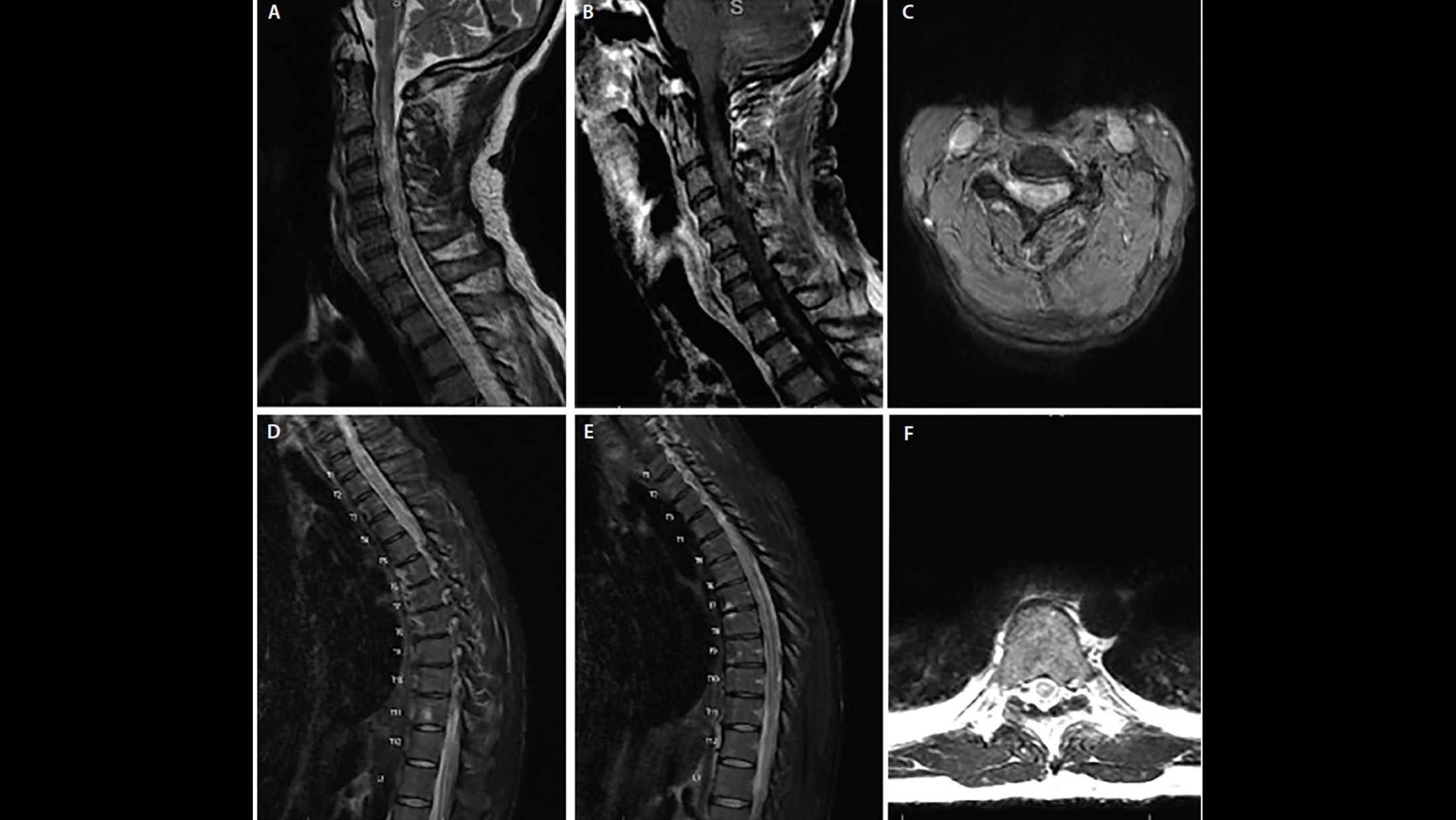 early ms mri spine