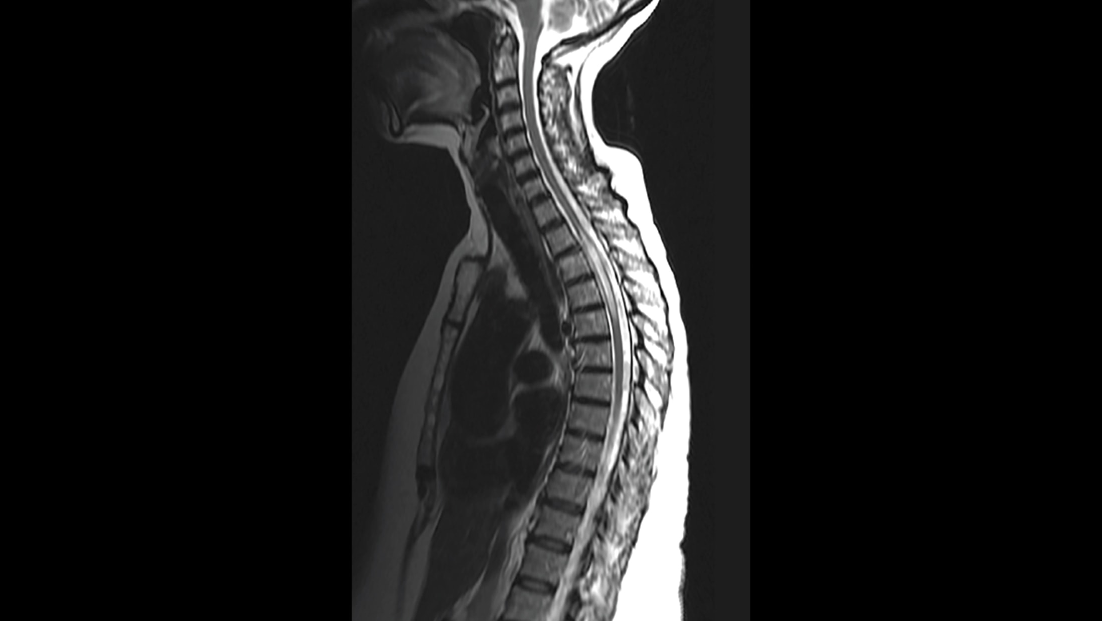 Spinal Cord Lesions - The Neurology Hub