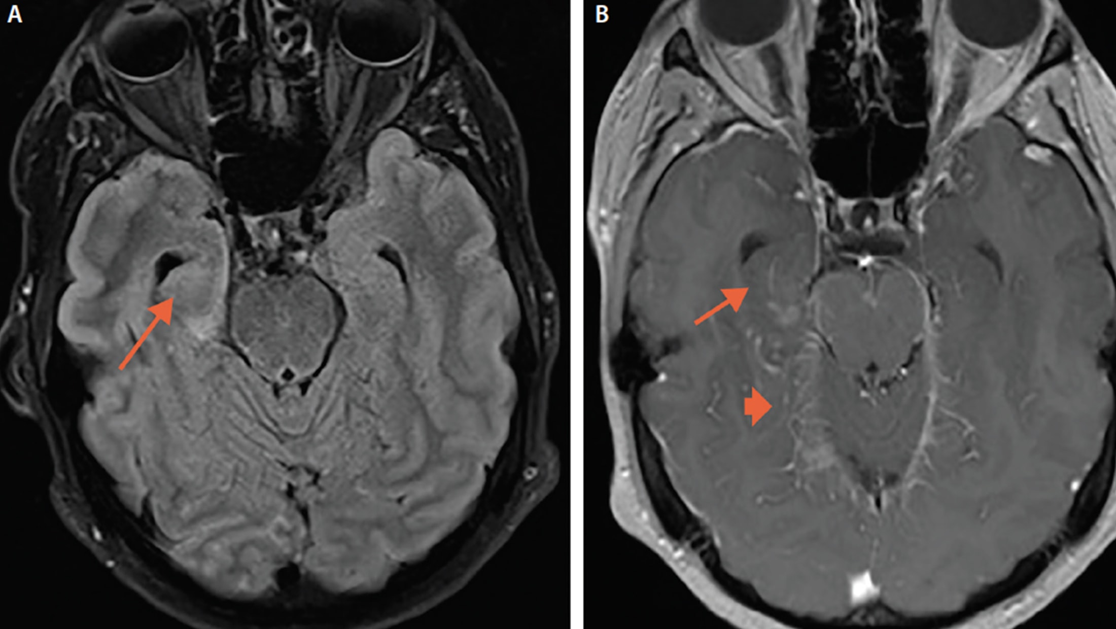 Temporal Lobe Lesions The Neurology Hub