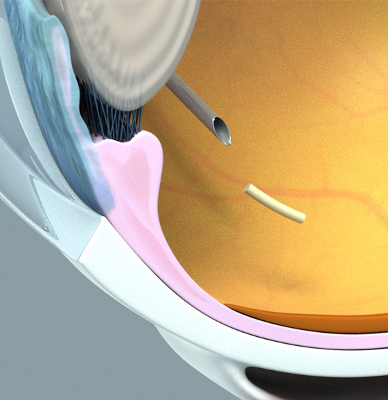 Otsk Inj Finding Another Solution: An Update on OTX-TKI - Retina Today