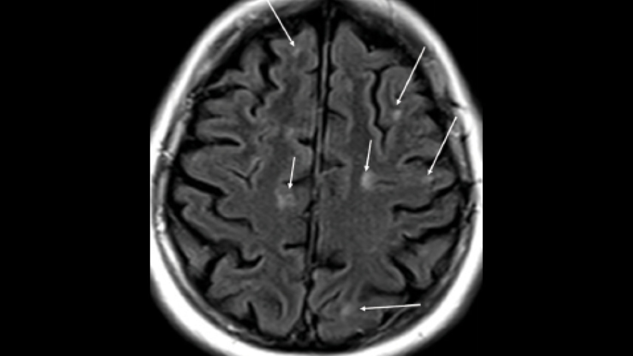 U-fiber Lesions - The Neurology Hub