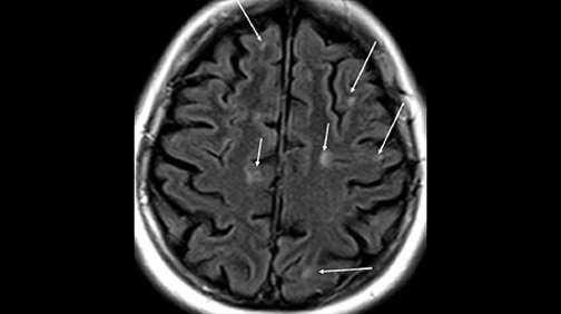 Cerebellar Lesions - The Neurology Hub